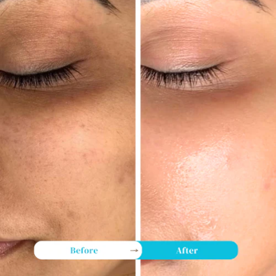 CUTE-E Cream Advanced Formula | For Melasma, Pigmentation & Dark Spots | Reduces Uneven Tone & Discoloration with Nature + Science Blend