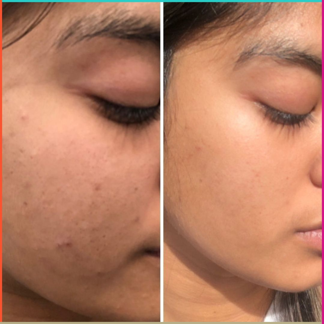 Novology Acne Rescue Spot Corrector Gel | Reduces Active Acne Without Dryness