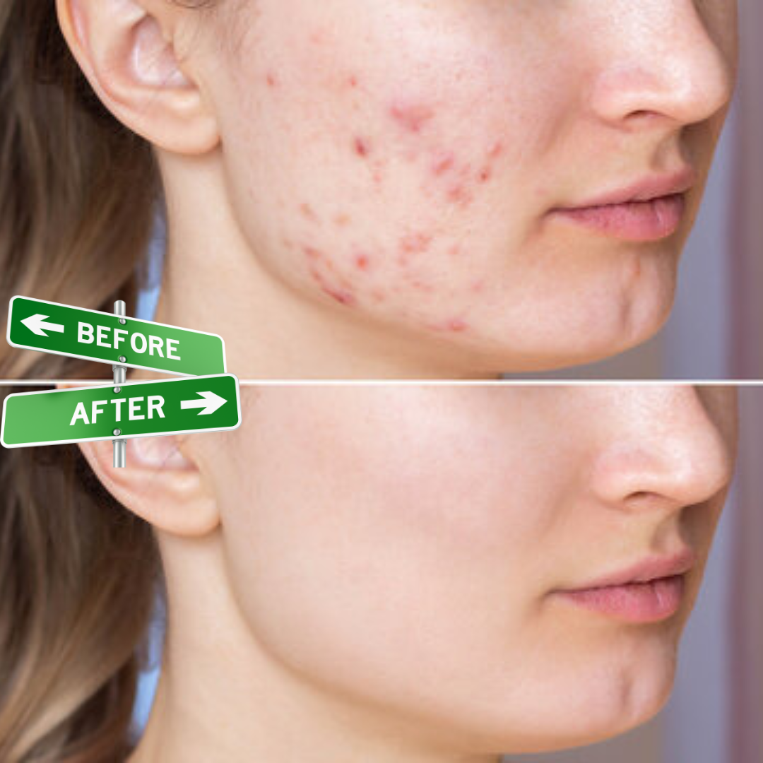 Acne & Acne Scars Removal Cream | Salicylic Acid + Niacinamide + Hyaluronic Acid + Tea Tree | Reduces Breakouts, Fades Scars & Evens Skin Tone