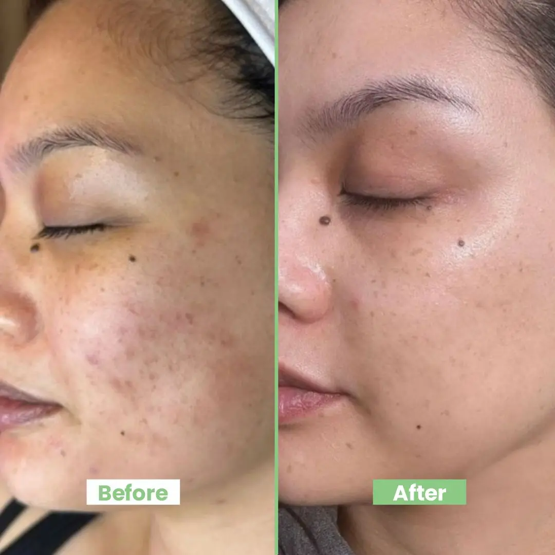 CUTE-E Cream Advanced Formula | For Melasma, Pigmentation & Dark Spots | Reduces Uneven Tone & Discoloration with Nature + Science Blend