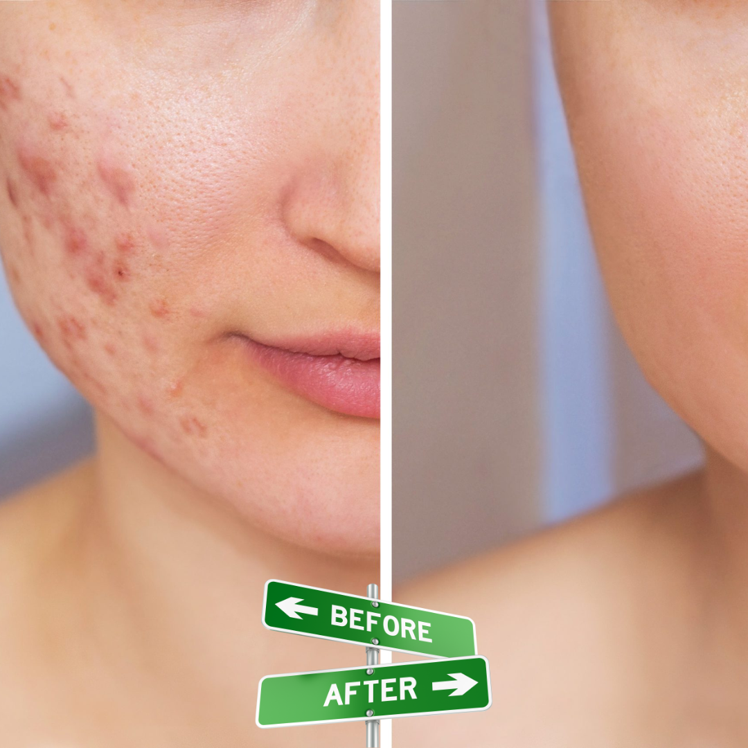 Acne & Acne Scars Removal Cream | Salicylic Acid + Niacinamide + Hyaluronic Acid + Tea Tree | Reduces Breakouts, Fades Scars & Evens Skin Tone
