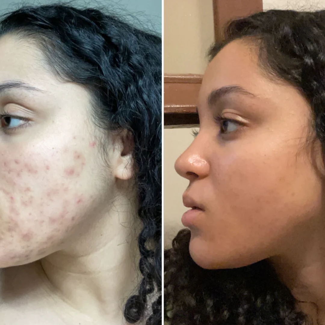 Conscious Chemist Acne Relief Gel | Reduces Pimples Fast | Controls Oil | Calms Redness