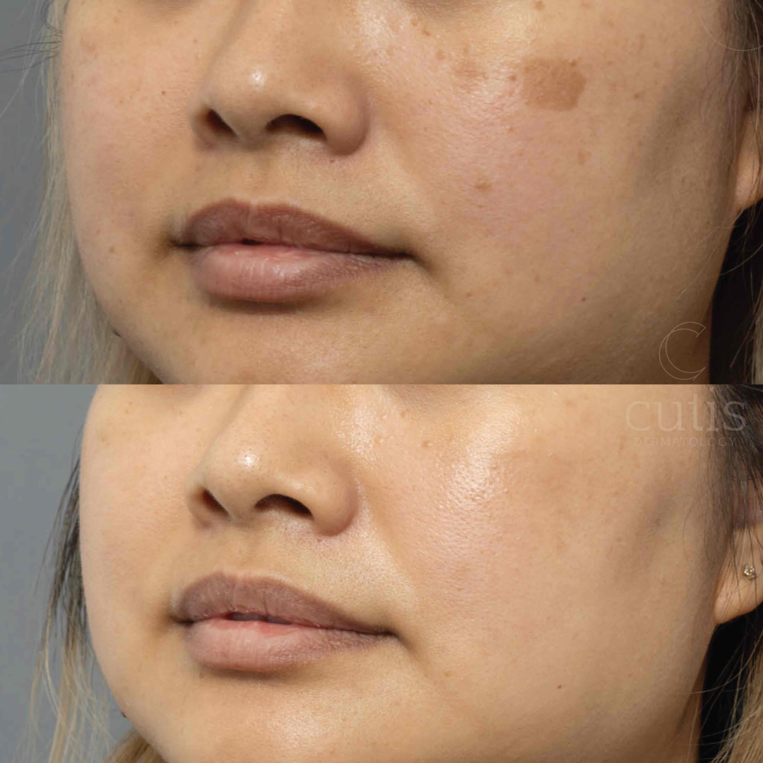 Dr. Melaxin Ultimate Skin Deal | Cyano Pink Spicule Serum + Picotonic Shot Ampoule | Pore Tightening, Anti-Aging & Anti-Pigmentation Duo