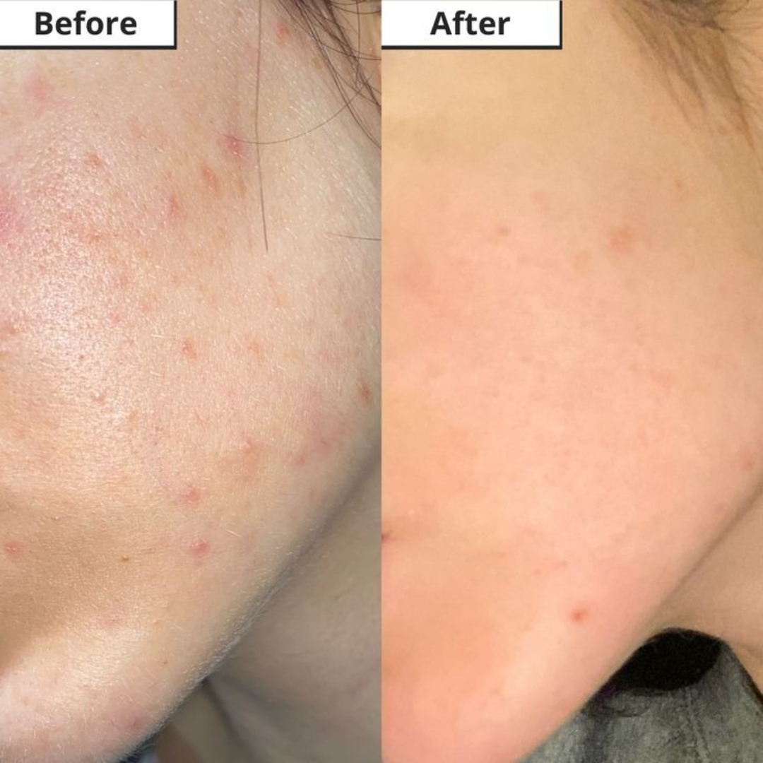 Novology Acne Rescue Spot Corrector Gel | Reduces Active Acne Without Dryness