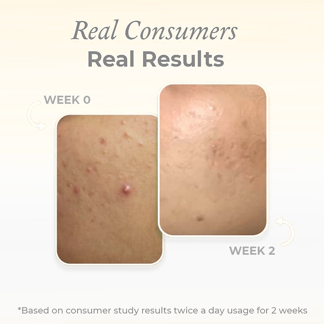 Novology Acne Rescue Spot Corrector Gel | Reduces Active Acne Without Dryness