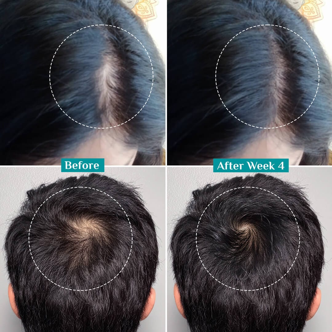 Dr. Alies Professional Red Onion & Black Seed Oil Hair Oil – 100% Natural – Stops Hair Fall, Strengthens Roots, Prevents Premature Greying – With Castor Oil – For Split Ends, Thinning Hair & Scalp Health